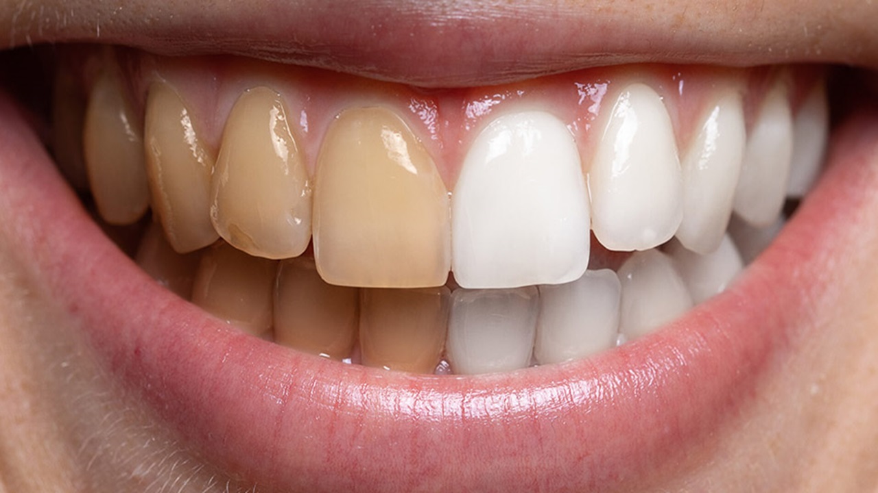 Understanding the Procedure for Ordering Custom Teeth Whitening Strips from OEM